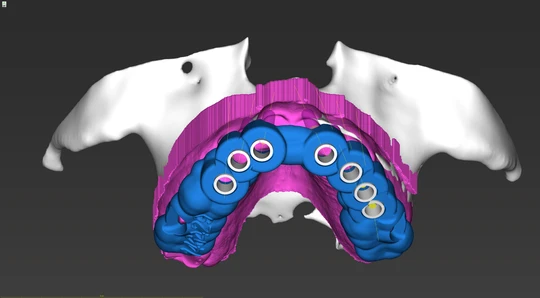 Planificación de implantes y guía quirúrgica en CoDiagnostiX