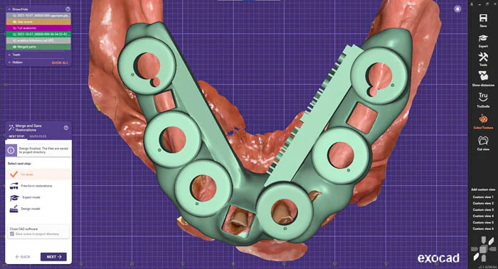 Diseño de guía quirúrgica full-arch en exoplan / exocad